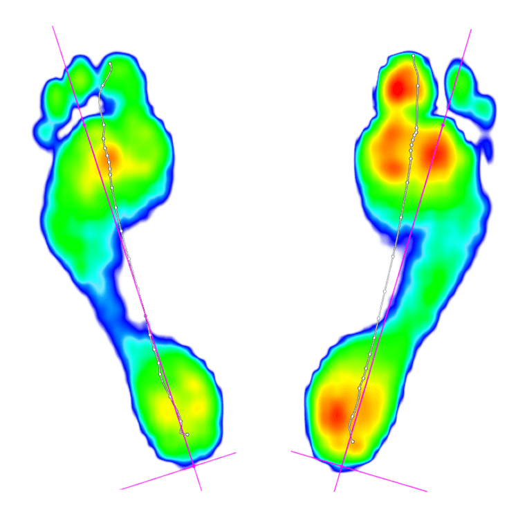 Plantar pressure