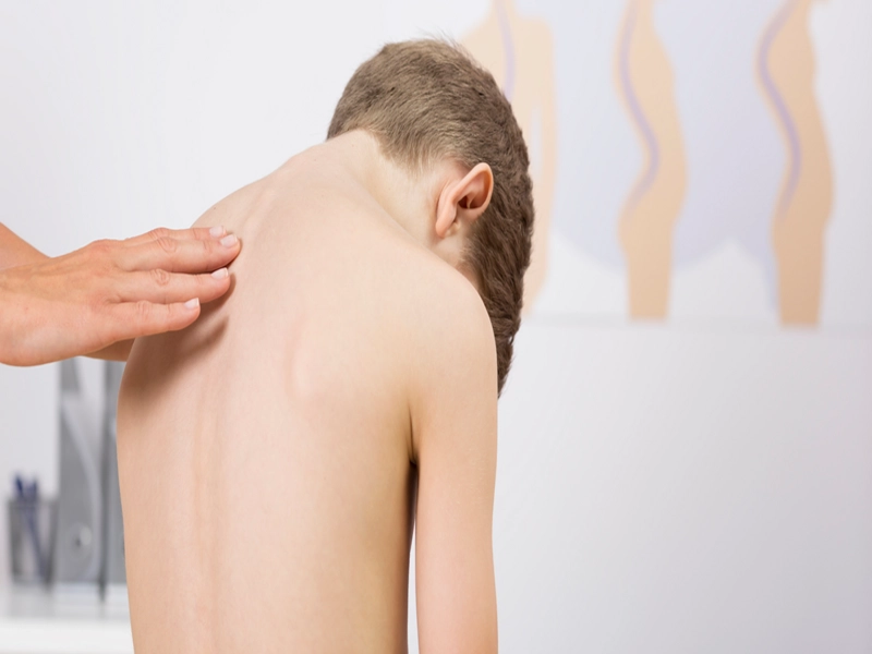 علت ایجاد عارضه اسکولیوز