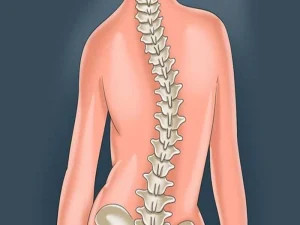 بررسی اسکولیوز