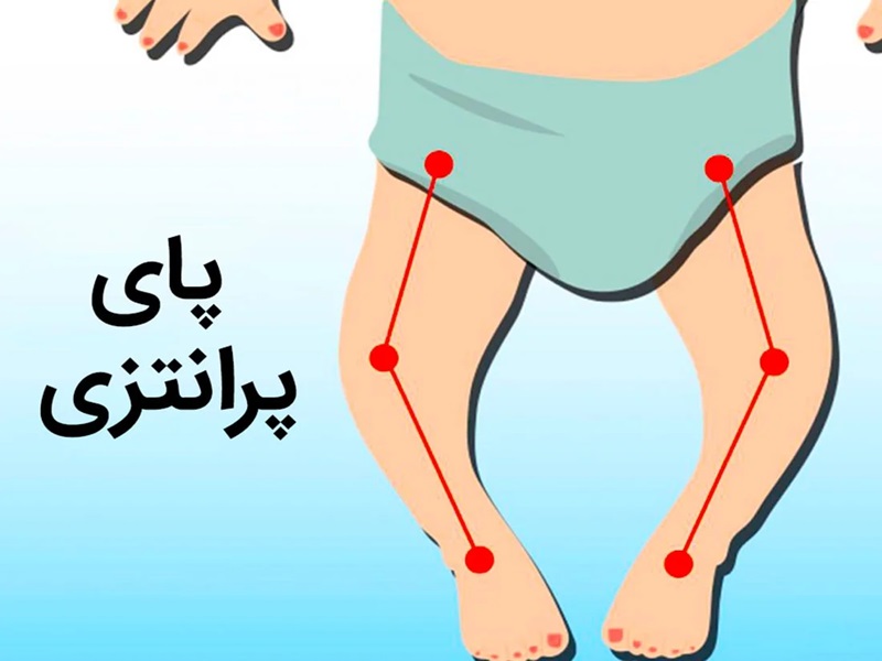 عوارض پای پرانتزی در کودکان