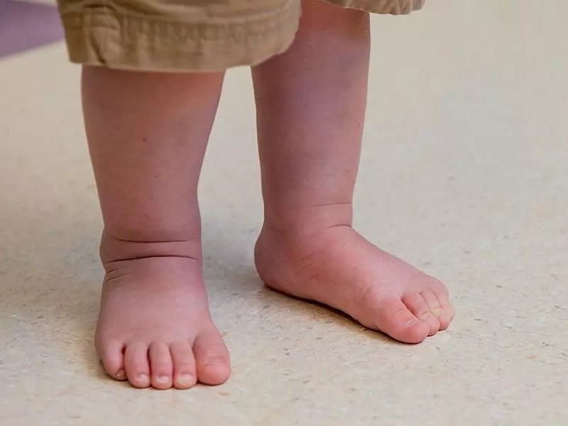 کف پای صاف در اثر تالوس عمودی