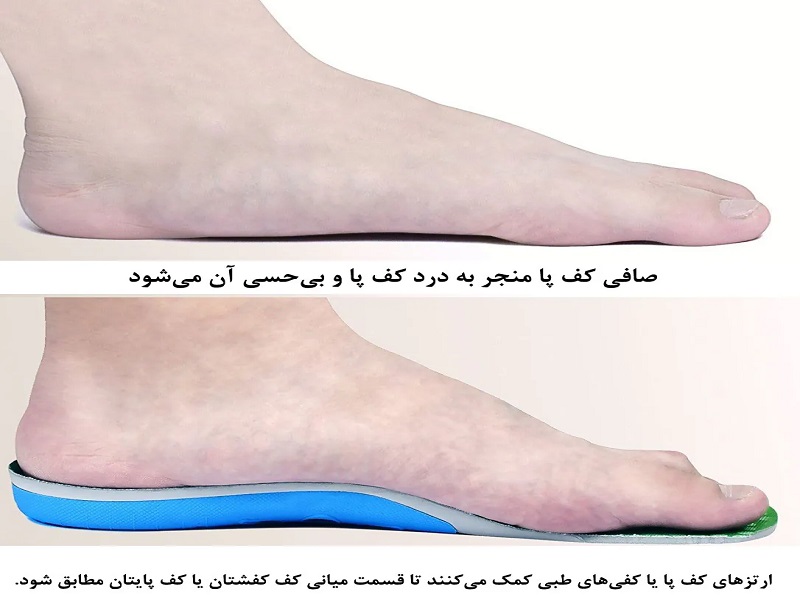 مزایای استفاده از کفش طبی برای کف پای صاف