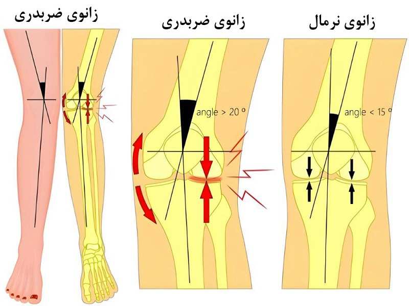 درک زانوی ضربدری