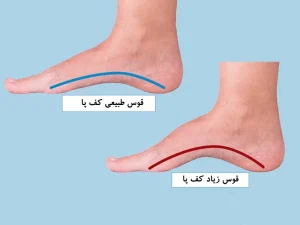 گودی یا قوس زیاد کف پا؛ علل، علائم و روش‌های درمان